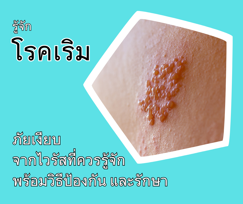 รู้จักโรคเริม ภัยเงียบจากไวรัสที่ควรรู้จัก พร้อมวิธีป้องกัน และรักษา
