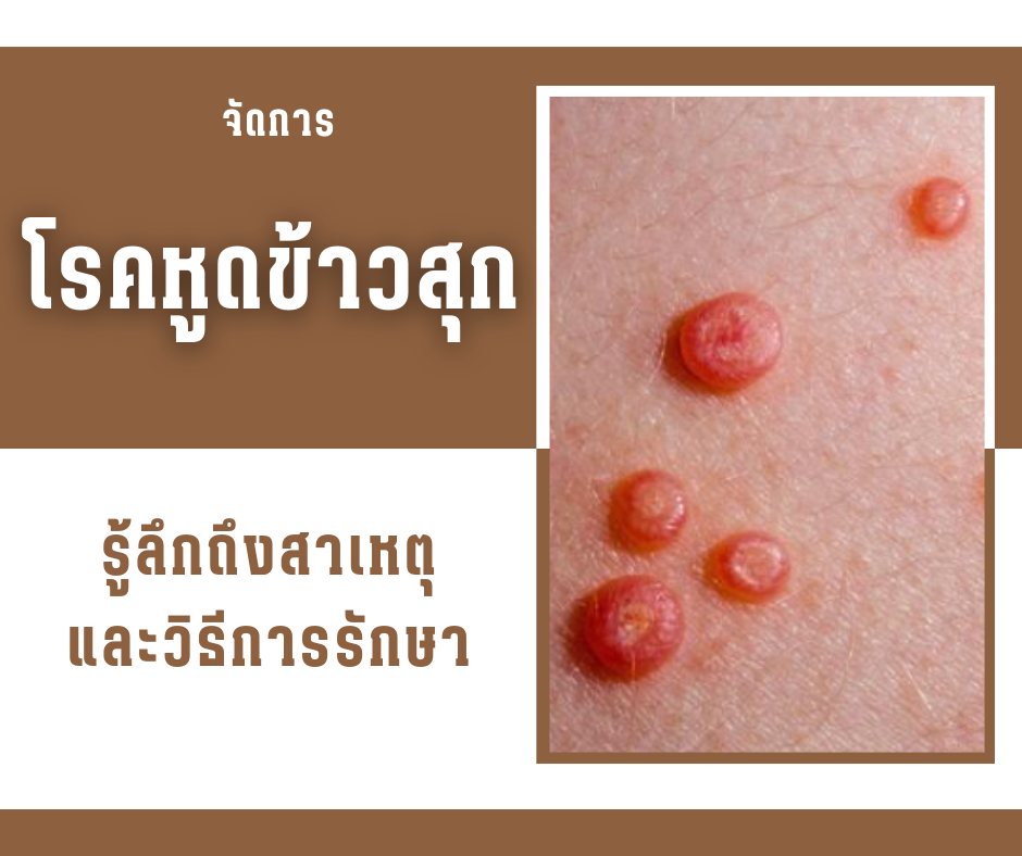 จัดการโรคหูดข้าวสุก รู้ลึกถึงสาเหตุ และวิธีการรักษา