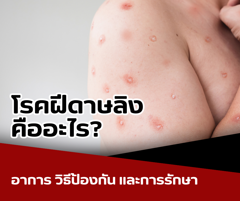 โรคฝีดาษลิง คืออะไร? อาการ วิธีป้องกัน และการรักษา