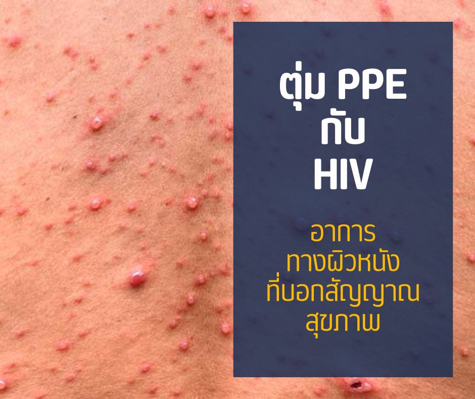 ตุ่ม PPE กับ HIV อาการทางผิวหนังที่บอกสัญญาณสุขภาพ