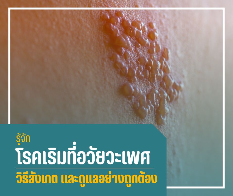 รู้จักโรคเริมที่อวัยวะเพศ วิธีสังเกต และดูแลอย่างถูกต้อง